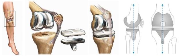Ендопротезиране на колянната става - Рехабилитация