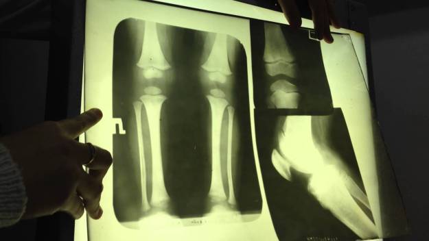 Рентген на колянната става