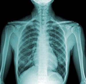 4 скрити опасности от остеохондроза на гърдата