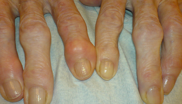 Причини и лечение на пръст полиартрит
