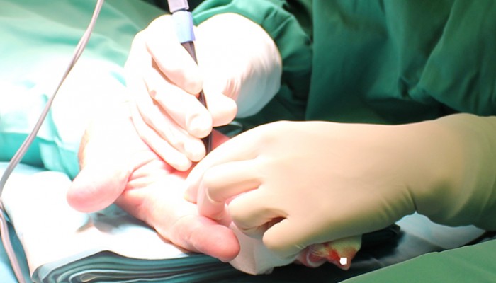 Конуси върху ставите на пръстите: лечение