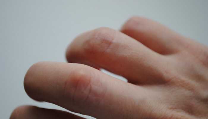 Конуси върху ставите на пръстите: лечение