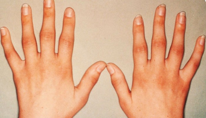 Деформиране на артрозата на ръцете: симптоми и лечение
