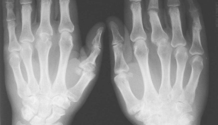 Остеоартрит на малки стави на ръцете: лечение