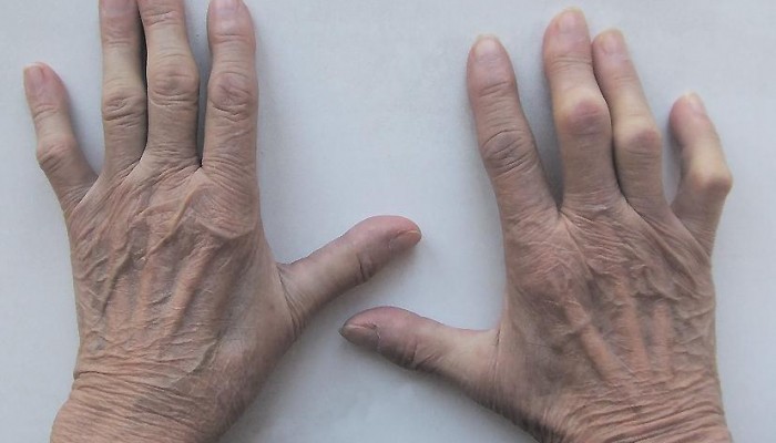 Болка в ставите на пръстите: причини и лечение