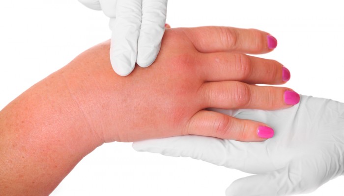 Болка и подуване на ставите на пръстите: методите на лечение
