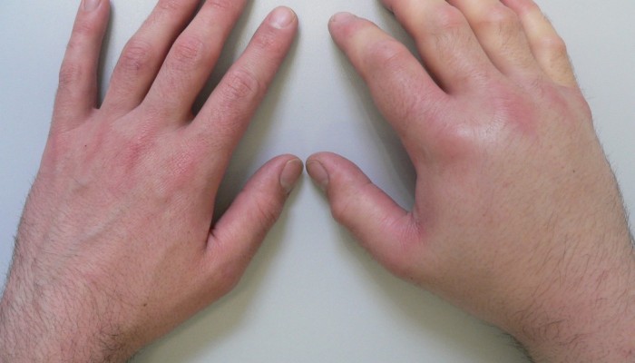 Болките на ръцете боли: причините и лечението