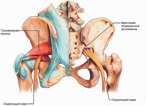 Блокада - начин за облекчаване на синдрома на крушовидния мускул