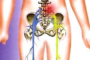 Възпаление на седалищния нерв или ишиас: симптоми и лечение на заболяването