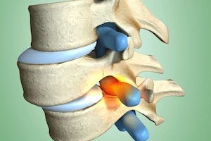 Причини, симптоми и лечение на гръбначната нестабилност при остеохондроза