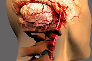 Остеохондроза и инсулт - как са заболявания, симптоми, рехабилитация след кръвоизлив в мозъка