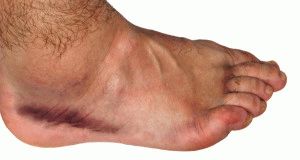 Причини и лечение на оток на краката