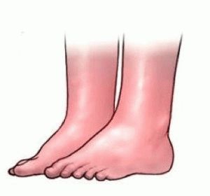 Причини за подуване на краката при жените