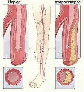 Причини за изтръпване на крака под коляното