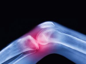 Ефективни народни средства за болки в коляното