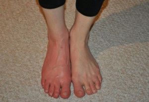 Как да се излекува болката в краката под пръстите при ходене