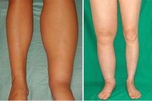 Как да премахнете оток на крака с лимфостаза