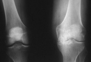 Как да използвате бреза катран за болка в коляното