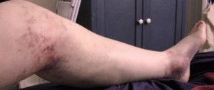 Левият долен крак набъбва: причини и как да се лекува