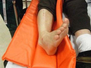 Защо боли метатарзалната кост на крака?