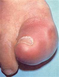 Защо боли ноктите на големия пръст?