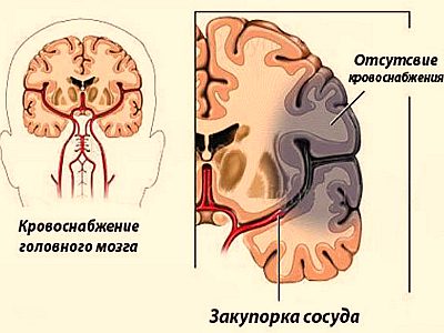 Характерни особености на мозъчния инфаркт