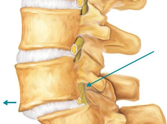 Анестезия на гръбнака: симптоми и лечение
