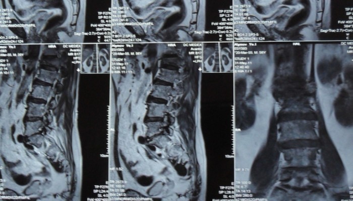Рак на гръбначния стълб: симптоми и лечение