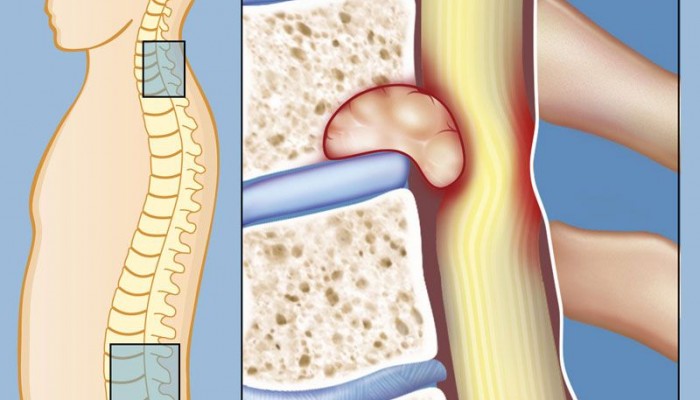 Рак на гръбначния стълб: симптоми и лечение