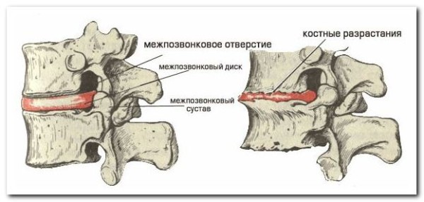 Деформиране на спондилозата на цервикалния гръбначен стълб