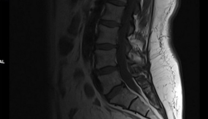 Деформиране на спондилозата на лумбосакралния гръбначен стълб: симптоми и лечение