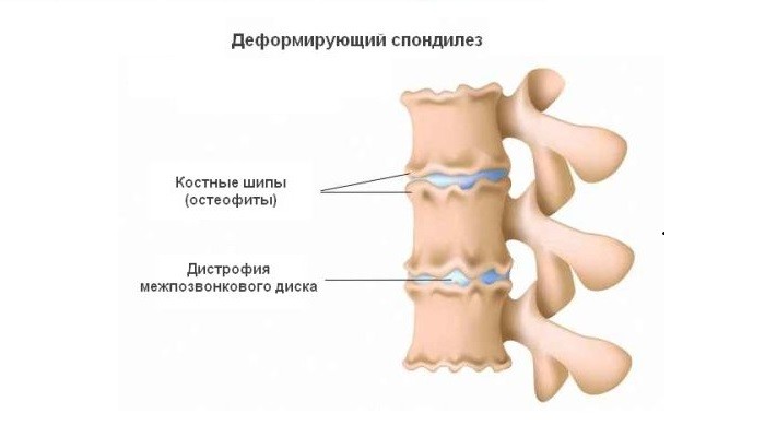 Деформиране на спондилозата на лумбосакралния гръбначен стълб: симптоми и лечение