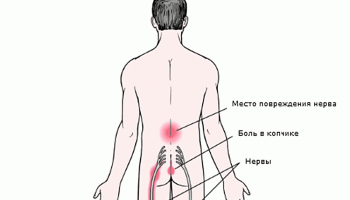 Дискогенна радикулопатия на лумбосакралния гръбначен стълб