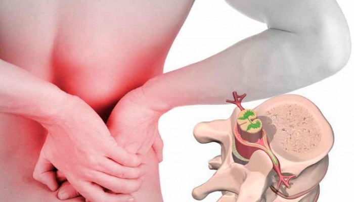 Херния на лумбосакралния гръбначен стълб: причини, симптоми и лечение