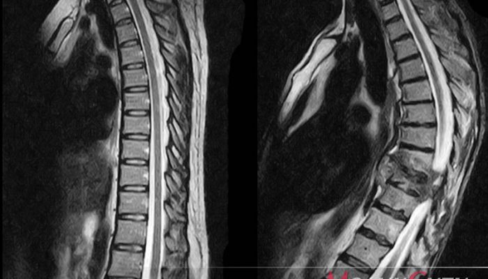 Как да се лекува остеопороза на гръбначния стълб?
