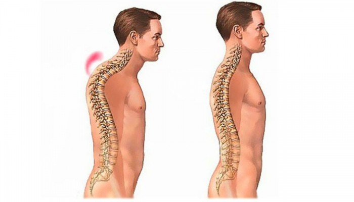 Кфиотична деформация на гръбнака: какво е това?