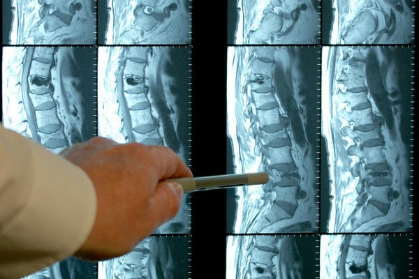 Удари на нервите в лумбалната част на гръбначния стълб: лечение
