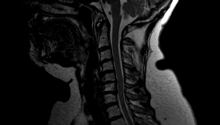 Спондилартроза на шийката на гръбначния стълб: какво е това?