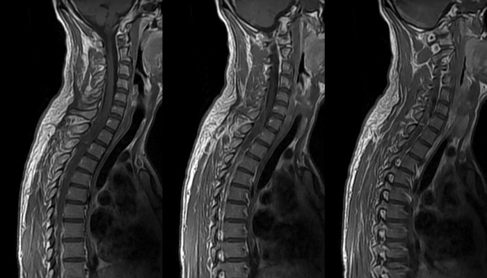 Ход на гръбначния мозък: симптоми и лечение