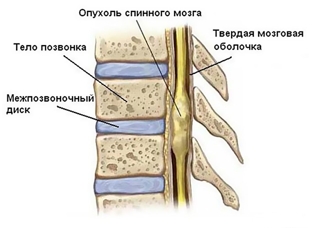 Симптоми и лечение на тумори на гръбначния мозък
