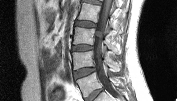 Сиригенемия на гръбнака: причини, симптоми и лечение