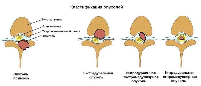 Лечение на менингиома на гръбначния мозък