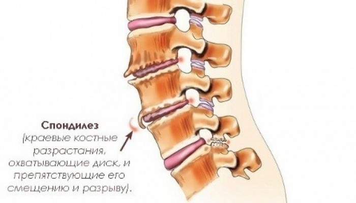 Какво представлява спондилозата на гръбначния стълб?