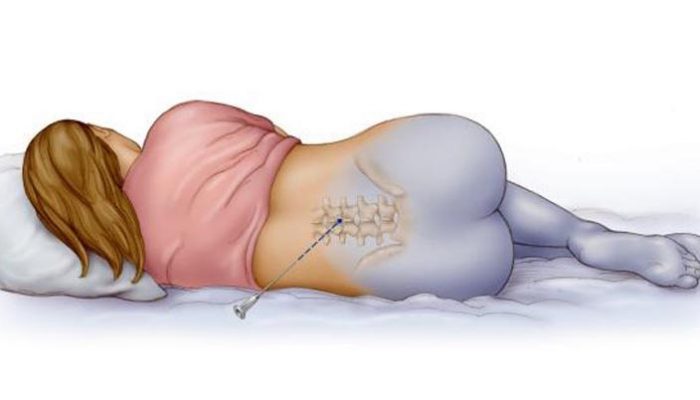 Анестезия в гръбначния стълб: противопоказания и последствия