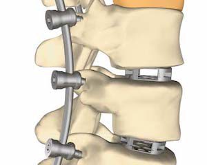 Назначаване, видове и особености на стабилизирането на гръбначния стълб