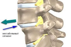 Назначаване, видове и особености на стабилизирането на гръбначния стълб