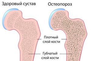 Остеопороза на гърба: клинични прояви, лечение и упражнения