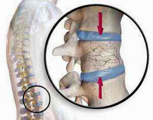 Причини, симптоми и лечение на неусложнени наранявания на гръбначния стълб