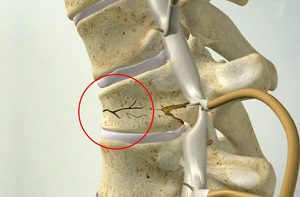 Причини, симптоми и лечение на неусложнени наранявания на гръбначния стълб