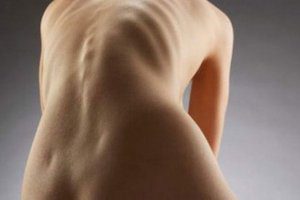 Нарушение на развитието на гръбначния стълб: кифосколиоза
